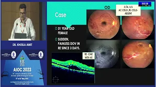 AIOC2023   IC66 topic DR  KHOSLA AMIT Mistakes in non infectious uveitis