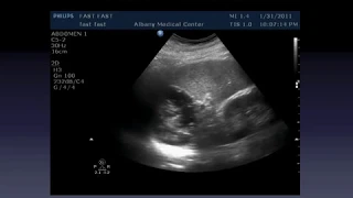 FAST Scan   Ultrasound Lecture