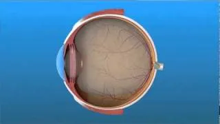 Vitrectomy Surgery for Detached Retina