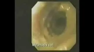 Видео толстого кишечника изнутри
