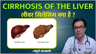 Cirrhosis of the Liver : लीवर सिरोसिस क्या है ? – लक्षण और कारण | लिवर सिरोसिस हो सकता है जानलेवा