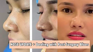 NOSE UPDATE (Dealing with Post Surgery Blues After Rhinoplasty) | Jen Barangan