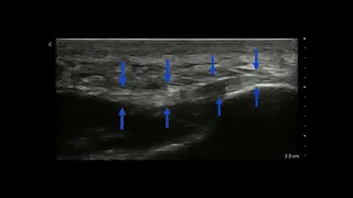 Plantar Fasciitis Ultrasound