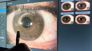Eye With Post Lasik Corneal Ectasia After Intacs Ring Was Removed