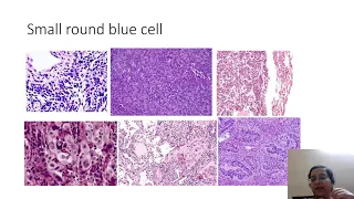 Pathological approach to mediastinal tumors-pearls and tips