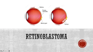 Retinoblastoma - A Clinical Overview for Medical Students