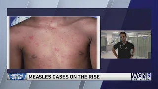 Spring Break travel concerns as Measles cases climb