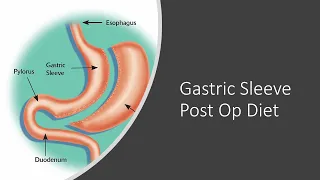 Gastric Sleeve Post Op Diet