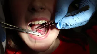 Main Suture Technique for Ranula