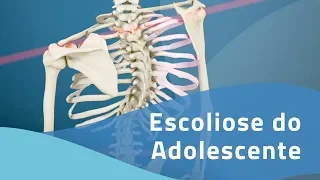 ESCOLIOSE DO ADOLESCENTE