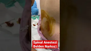 Spinal anestezi (belden narkoz),sezaryen doğum,keyseriyye emelşyyatı,narkoz