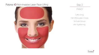 Fotona 4D   Fotona Laser: The Revolutionary Non-Surgical Face Lifting Procedure