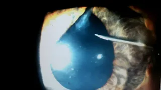 Slit Lamp Procedures: AC reformation