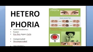 Ophthalmology 357 HeteroPhoria Latent Strabismus Squint Compensation DeCompensation