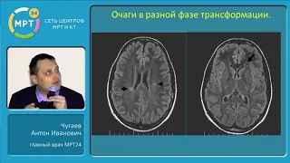 МР-диагностика демиелинизирующих заболеваний головного мозга