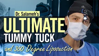 Dr. Salameh's Ultimate Tummy Tuck & 360 Degree Lipo | Salameh