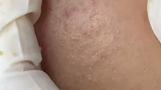 464 Blackheads, Acne Under The Skin   Mụn Đầu Đen Mụn Ẩn Dưới Da   SacDepSpa#279