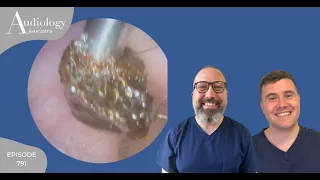 EAR WAX REMOVAL COMPILATION: DEEP PLUGS, SKIN REMOVALS & NARROW EAR CANALS - EP791