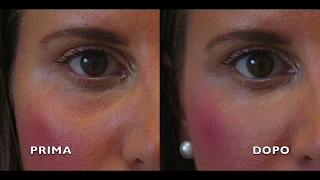 Medicina estetica per il viso: Trattamento Occhiaie - Dr Riccardo Marsili