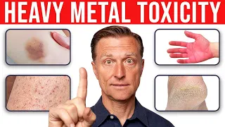 4 Skin Signs That Reveal Heavy Metal Toxicity