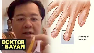 Simple Tricks to know if you have a Heart Failure (Congenital Heart Disease)  by Doc Willie Ong