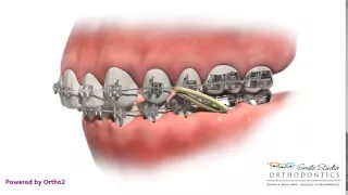 Elastics - Class II - Orthodontic Treatment