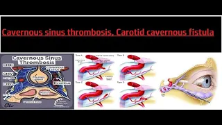 Cavernous sinus thrombosis, Carotid–cavernous fistula #kanskiseries #2022 #2023