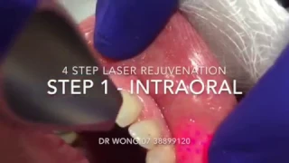 Non Surgical 4 Step or 4D Laser Face Lifting & Firming procedure  Brisbane