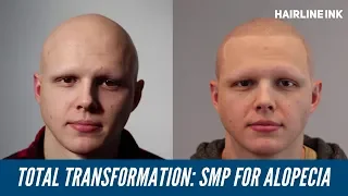 TOTAL TRANSFORMATION | Alopecia Treated with SMP 😮