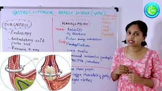 Gastroesophageal Reflux Disease (GERD) explained in Malayalam. NCLEX-RN , HAAD ,DHA important topic