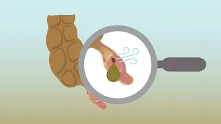 Identifying acute appendicitis on abdominal CT