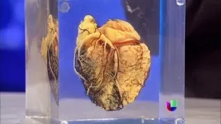 ¿Cómo ocurre un infarto al corazón?