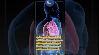 Apollo Hospitals | What are some myths regarding tuberculosis? | Dr Kashmira Jhala