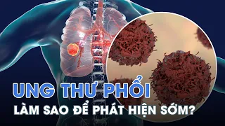 Những triệu chứng bất thường cảnh báo UNG THƯ PHỔI | Sức khỏe+ #suckhoecong