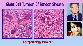 Pathology of Giant Cell Tumour Of Tendon Sheath by Dr Sampurna Roy MD  (dermpath, dermatopathology)