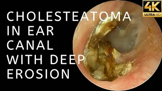 Cholesteatoma In Ear Canal With Deep Erosion (4K 60FPS)