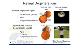 A Stem Cell-Based Therapy for Retinitis Pigmentosa