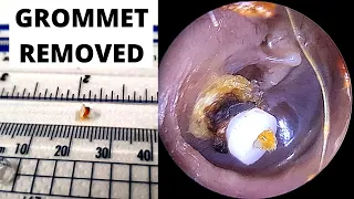 Shah Grommet Extracted From Ear Canal And Deep Retraction Pocket Seen (Pre Cholesteatoma)