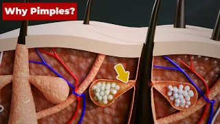 Why do we get PIMPLES? (3D Animation) #Shorts