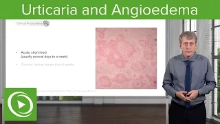 Urticaria (Hives) and Angioedema – Pediatrics | Lecturio