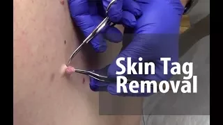 Skin Tag Removal | Dr. Derm