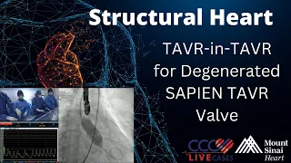 TAVR-in-TAVR for Degenerated SAPIEN TAVR Valve