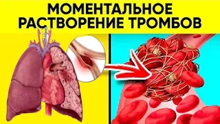 МОМЕНТАЛЬНОЕ растворение ТРОМБОВ