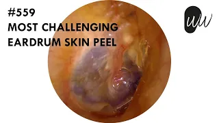 559 - Most Challenging Eardrum Skin Peel
