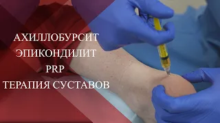 💉Бурсит ахиллова сухожилия и эпикондилит| PRP терапия суставов