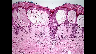 Inflammatory Dermatopathology for the Surgical Pathologist by Steven D. Billings, M.D.