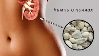 Дробление камней (ДЛТ): эффективно и безболезненно!