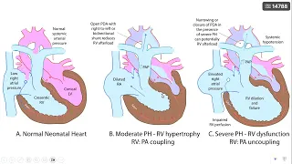 Pulmonary Hypertension  EUP Pediatric Cardiology Wheel #9 NICU #2 Dr Mohamed Abd Elfattah