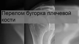 Перелом бугорка плечевой кости