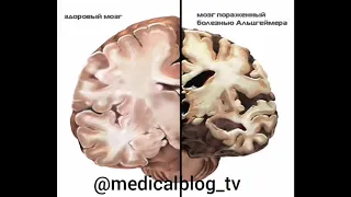 Тест на болезнь Альцгеймера